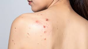 Vì sao da lưng dễ bị mụn? Nguyên nhân và cách cải thiện hiệu quả